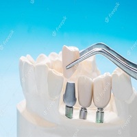 видове зъбни импланти - 29535 варианти