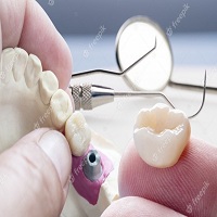 видове зъбни импланти - 12377 отстъпки