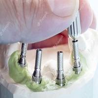 видове зъбни импланти - 59423 възможности