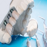 видове зъбни импланти - 93031 разновидности