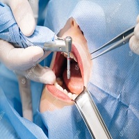 видове зъбни импланти - 13550 награди