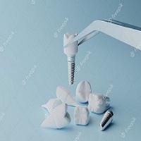 видове зъбни импланти - 27401 вида