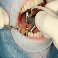 видове зъбни импланти - 35706 комбинации