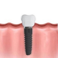 видове зъбни импланти - 92013 предложения