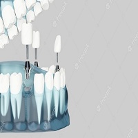 видове зъбни импланти - 70382 комбинации