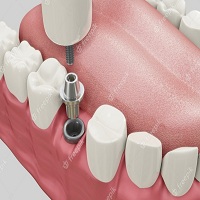 зъбни импланти цена - 9383 новини