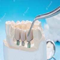 зъбни импланти цена - 56777 бестселъри