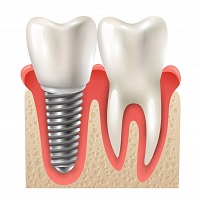 зъбни импланти цена - 87317 отстъпки
