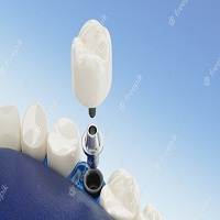 зъбни импланти цена - 67878 разновидности