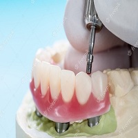 зъбни импланти цена - 13887 оферти